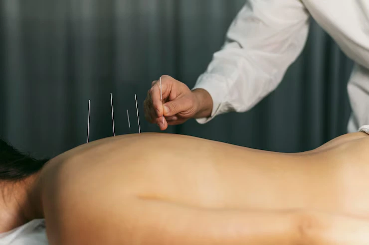 acupuncture-process_23-2148824045